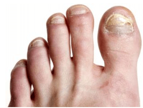 Nail filgus
