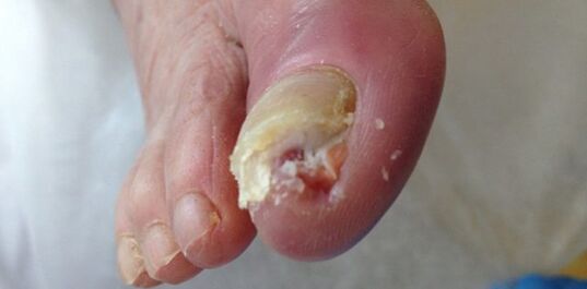 De Reservoir an d'Quell vun der Derormophytescher Champignonen ass eng krank Persoun