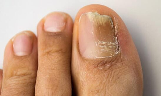 Distal-lateral Aart vu Schued mat Onychomycosis op d'Been